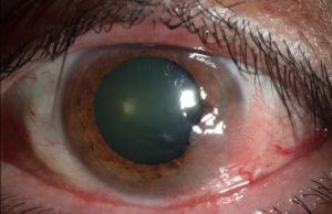 Ocular Surface Squamous Neoplasia