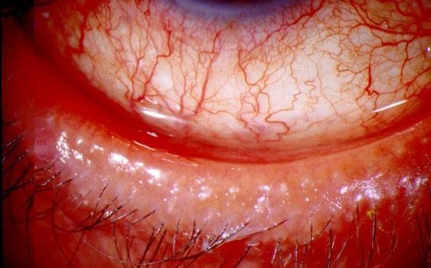 Ocular Rosacea: cast study, diagnosis and management
