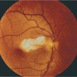 Arteritic Anterior Ischemic Optic Neuropathy