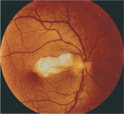 Arteritic Anterior Ischemic Optic Neuropathy