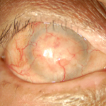 Ocular Cicatricial Pemphigoid