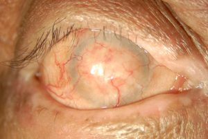 Ocular Cicatricial Pemphigoid (OCP): case study entity and management