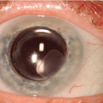 Ocular Surface Squamous Neoplasia