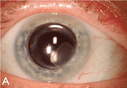 Ocular Surface Squamous Neoplasia (OSSN): A full study