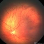 Retinopathy of Prematurity (ROP)