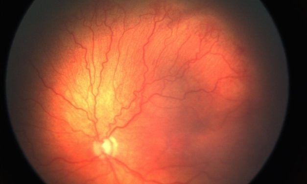 Retinopathy of Prematurity (ROP): Diagnosis and Management