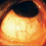 Loa Loa Filariasis