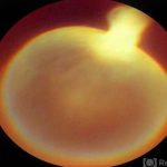 Ocular cysticercosis i