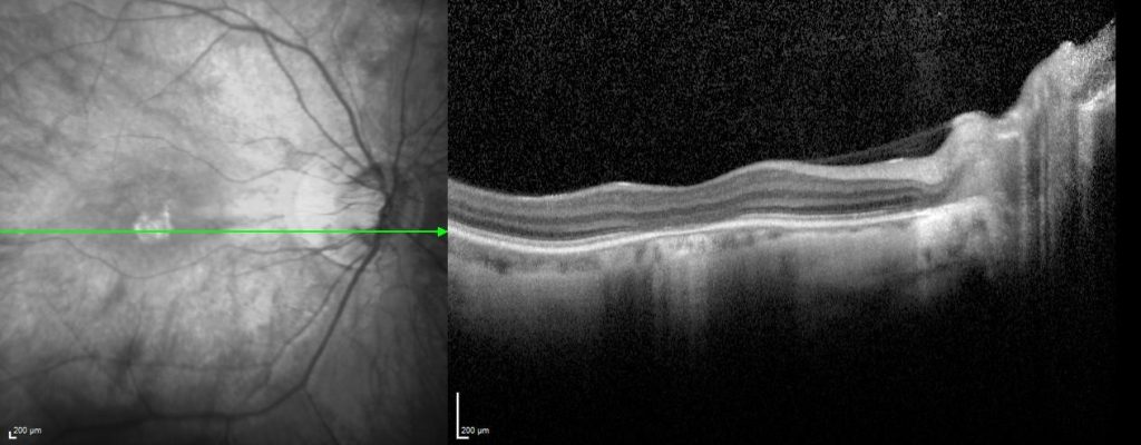 Achromatopsia