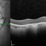 Achromatopsia