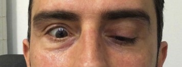 Ocular Neuromyotonia (ONM