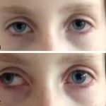 Ocular Neuromyotonia (ONM