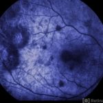 Acute Posterior Multifocal Placoid Pigment Epitheliopathy (APMPPE)