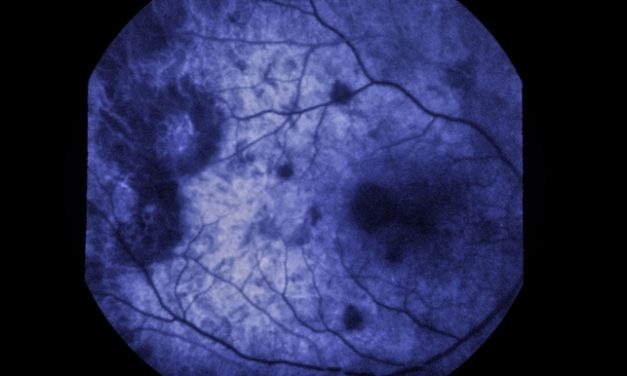 Acute Posterior Multifocal Placoid Pigment Epitheliopathy (APMPPE)