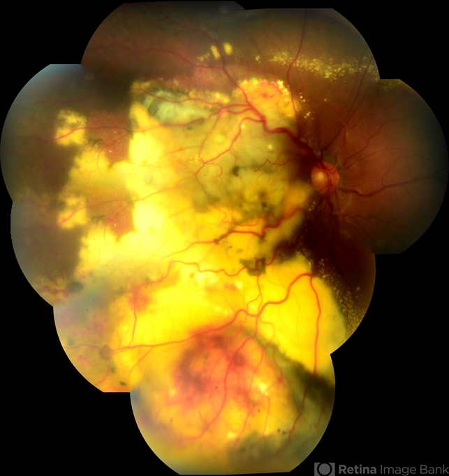 Leber's Miliary Aneurysm(LMA)