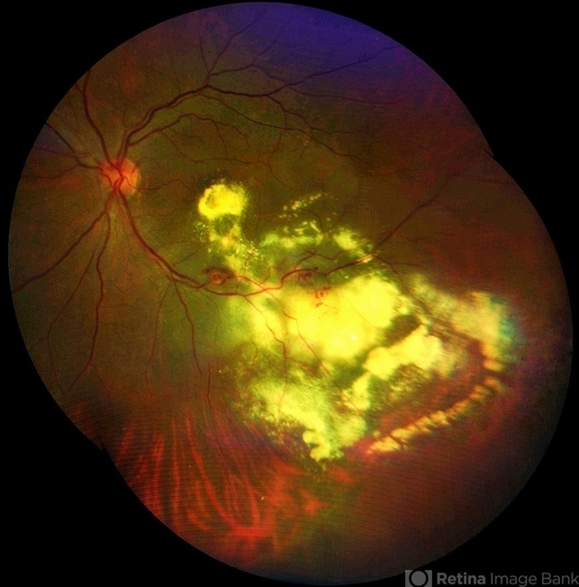 Leber's Miliary Aneurysm(LMA)