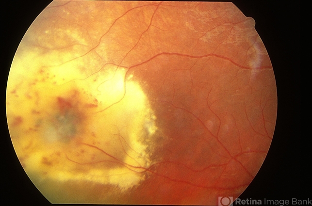 Leber's Miliary Aneurysm(LMA)