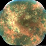 Relentless Placoid Chorioretinitis