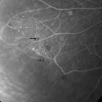 Retinal capillary nonperfusion