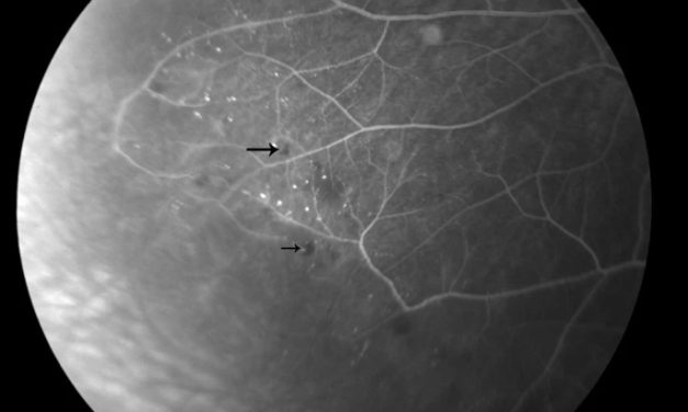 Retinal capillary nonperfusion: a full study