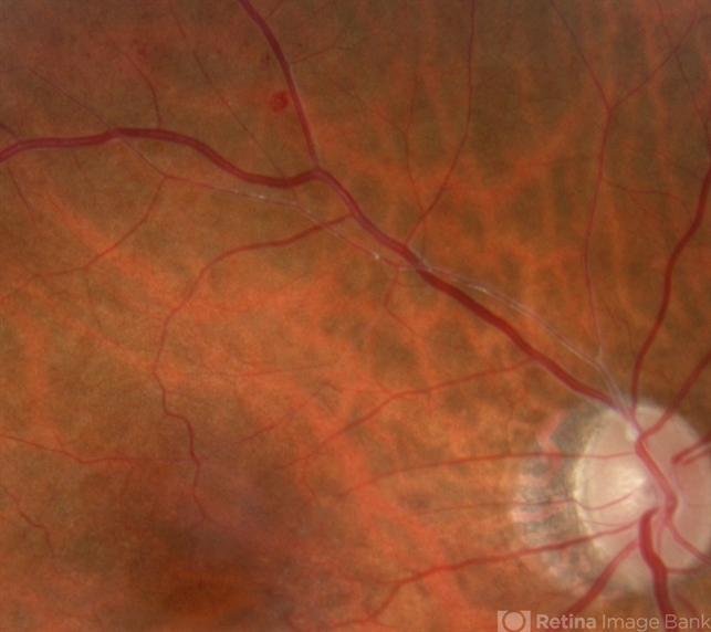Hollenhorst Plaque From A To Z Blog Ophthalmology Education Hollenhorst Plaque From A To Z Blog Ophthalmology Education