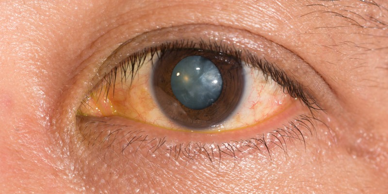 Nuclear Cataract