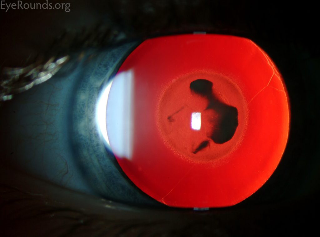 Nuclear Cataract