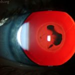 Nuclear Cataract