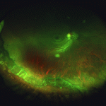 Vitreous base avulsion