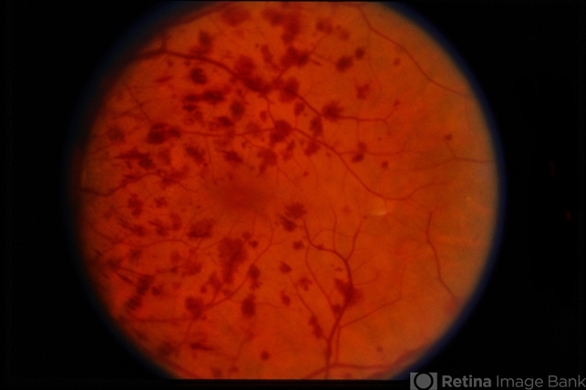 Venous stasis retinopathy