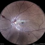 Venous stasis retinopathy