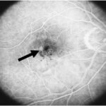 Retinal Angiomatous Proliferation (RAP): Management Strategies