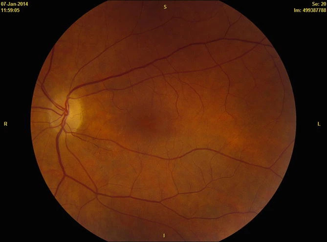 Melanoma Associated Retinopathy
