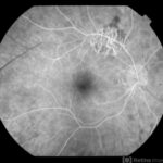 Melanoma Associated Retinopathy