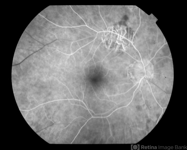 Melanoma Associated Retinopathy