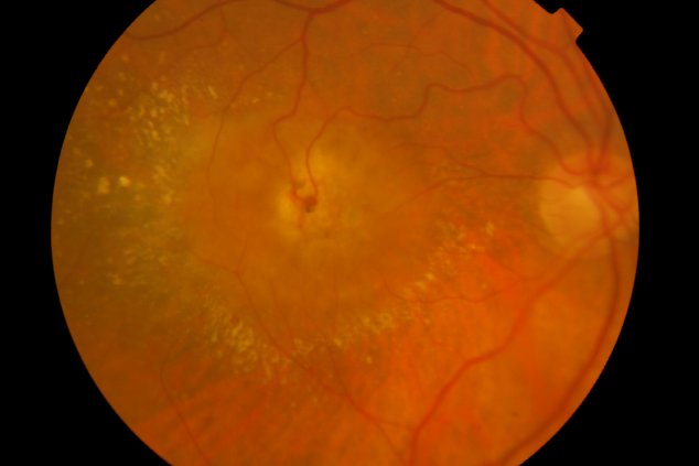 Retinal Angiomatous Proliferation (RAP): Management Strategies