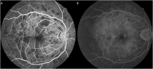 Cryptococcal Choroiditis