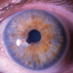 Acquired Ectropion Uveae