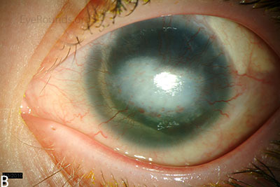 Aniridic Fibrosis Syndrome