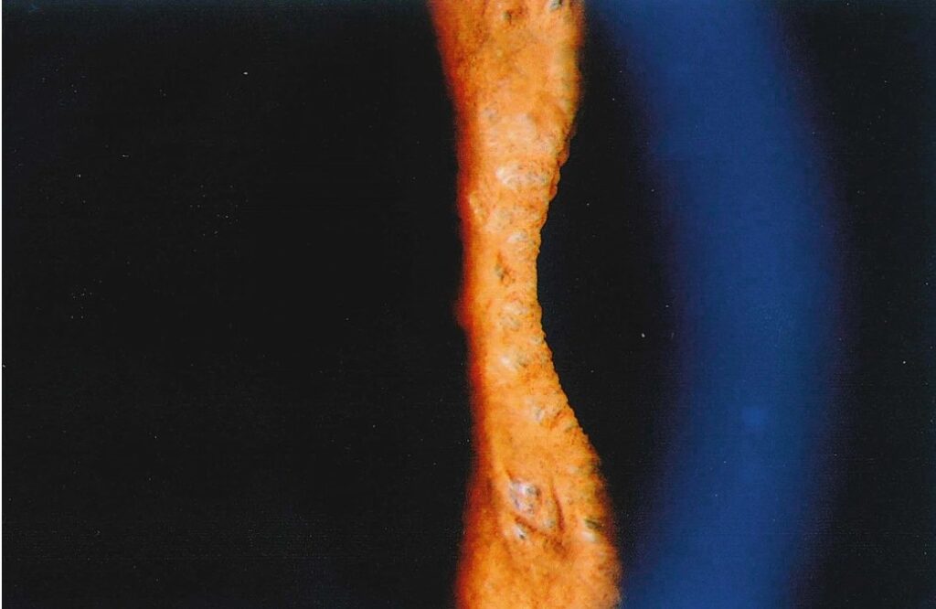 Posner-Schlossman Syndrome (PSS)
