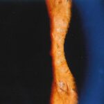Posner-Schlossman Syndrome (PSS)