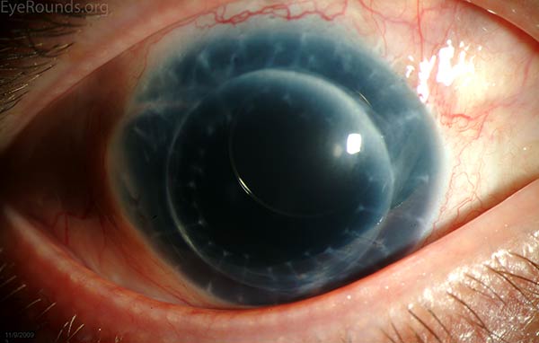 Aniridic Fibrosis Syndrome