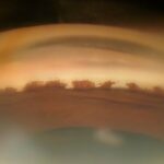 Sarcoid Uveitis