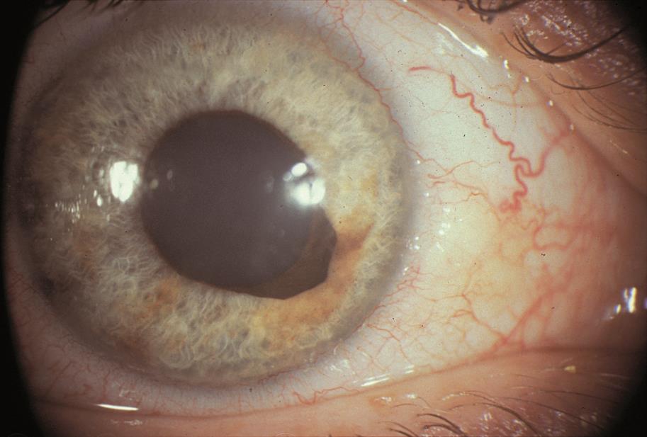 Acquired Ectropion Uveae