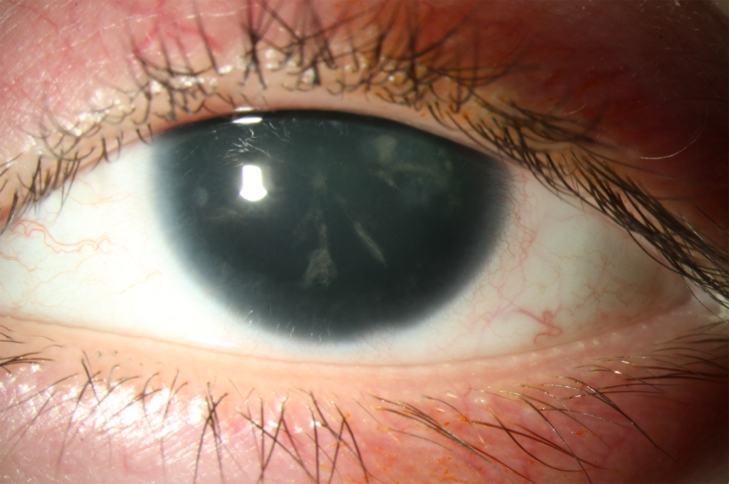 Aniridic Fibrosis Syndrome