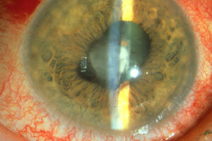 Sarcoid Uveitis