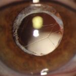 Snowflake cataract