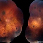 Bilateral Diffuse Uveal Melanocytic Proliferation (BDUMP)
