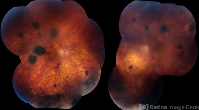 Bilateral Diffuse Uveal Melanocytic Proliferation (BDUMP)