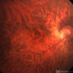 Fundus albipunctatus